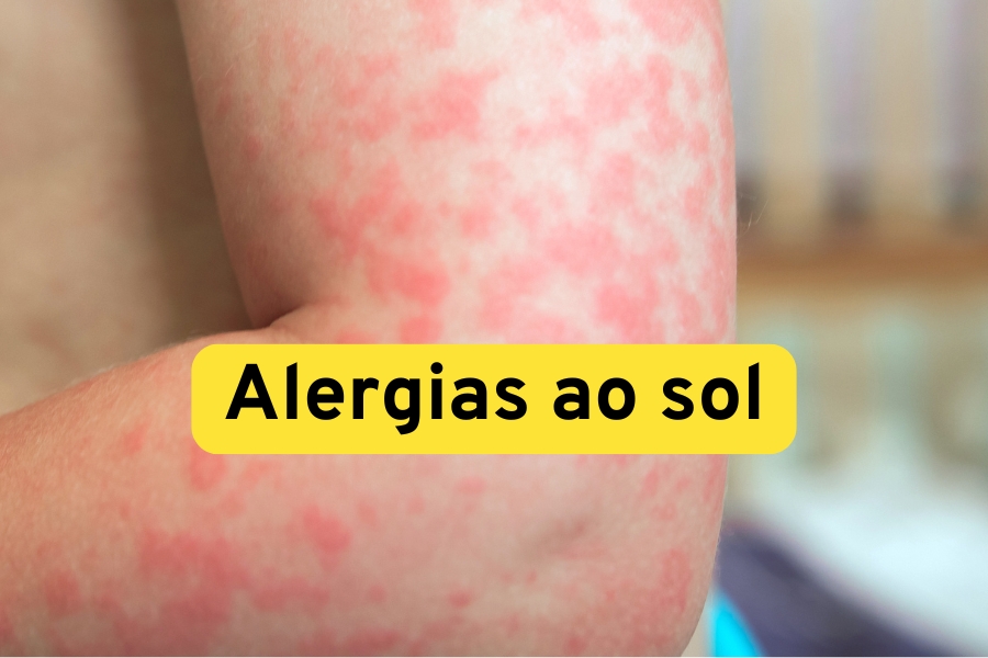 Descubra as principais alergias ao sol, seus sintomas e tratamentos eficazes para prevenir e controlar essas reações cutâneas.
